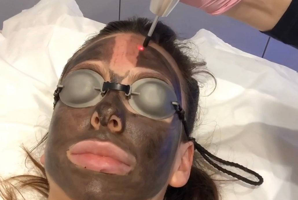 Carbon Laser Facial